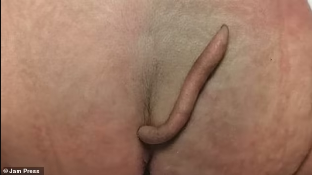 В Мексике родилась уникальная девочка: врачи обнаружили у нее хвост